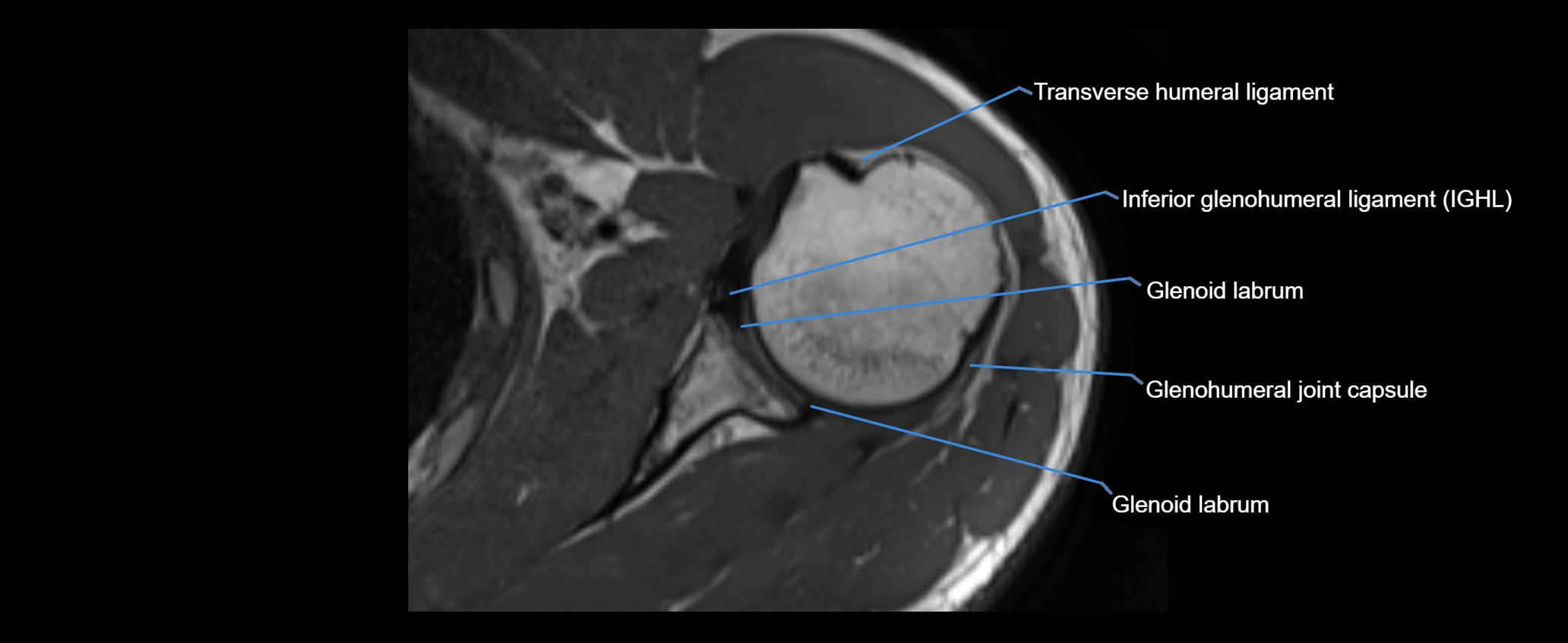 shoulder ligaments axial 3d 3t mri image-img-00005-00066.webp